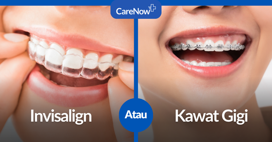 Invisalign dan Kawat Gigi: Mana yang Lebih Baik?